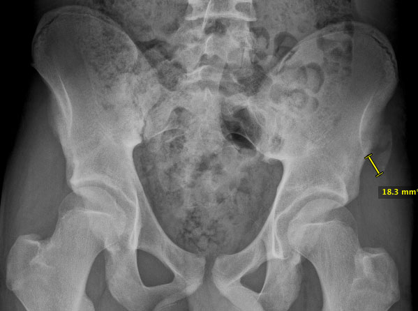 adolescent-injuries-around-the-hip_1