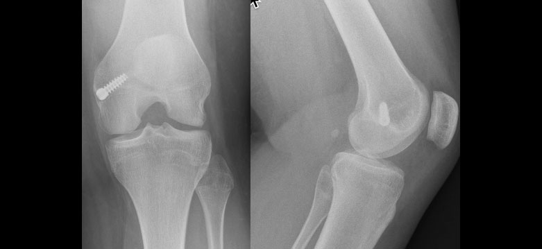 sports-injuries-patella-dislocation-1