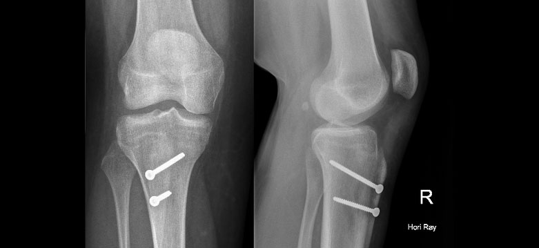 sports-injuries-patella-dislocation-2