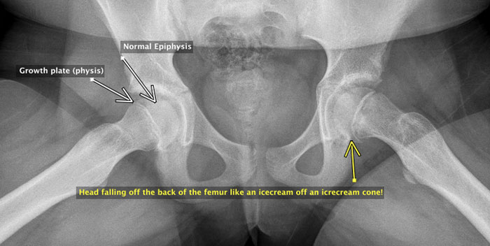 sports-injury-femur-xray1