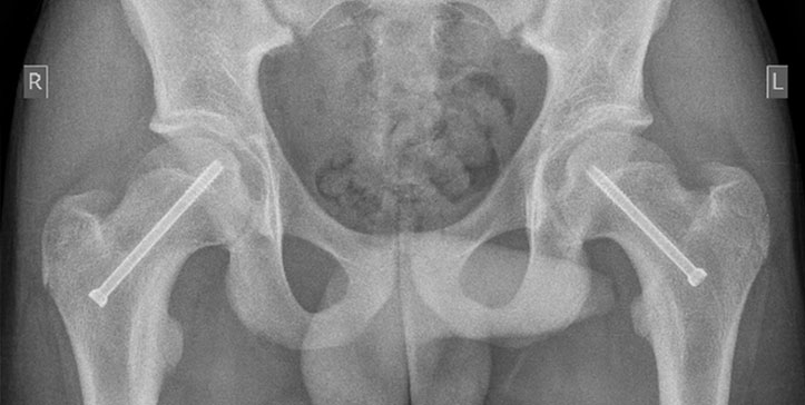 sports-injury-femur-xray2