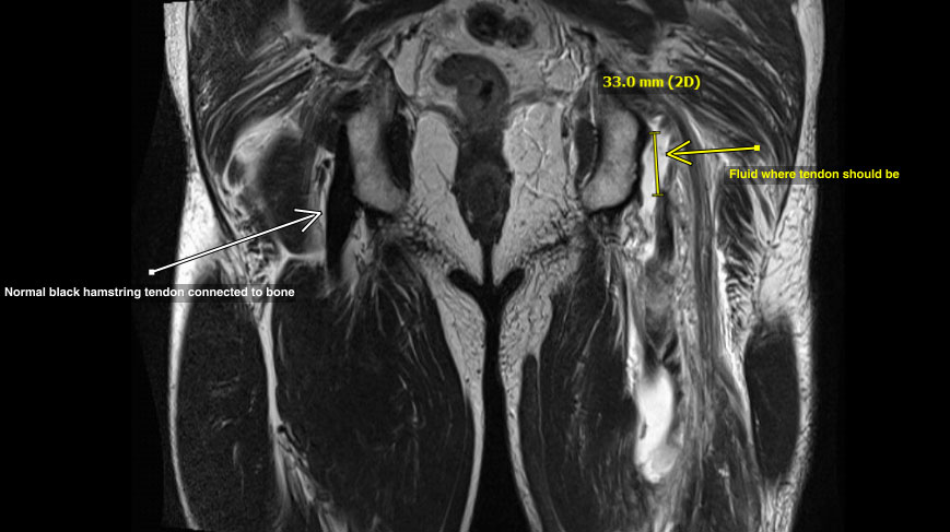 sports-injury-hip-mri